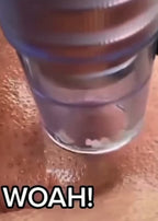 Blackhead Remover Pore Vacuum Cleaner